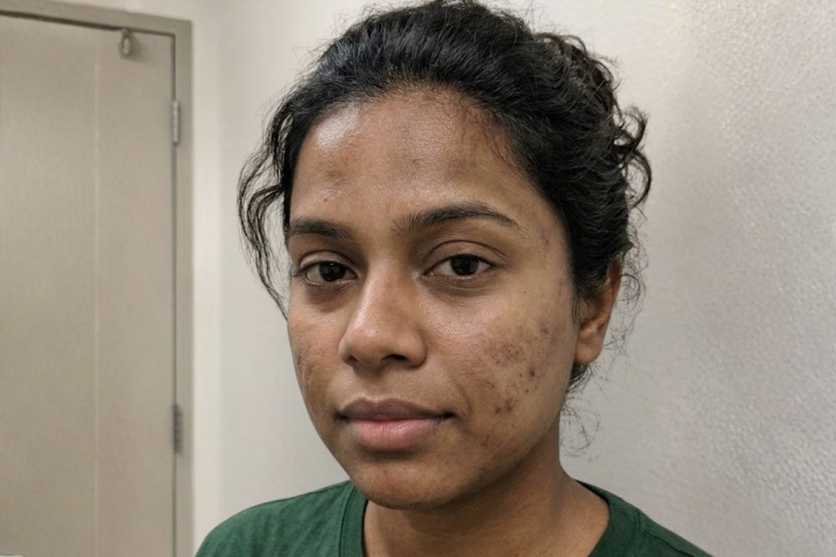 Before treatment